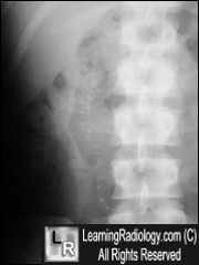 Ossification in scar